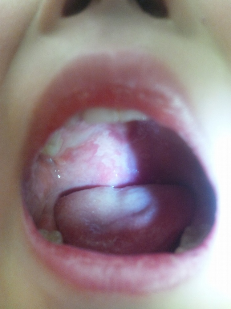 赤ちゃん 舌 鵞口瘡 画像